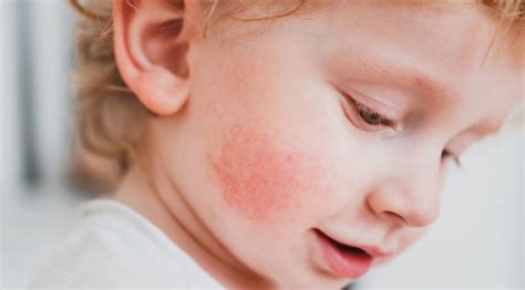 fotografia atopickej dermatitídy na detskej tvári