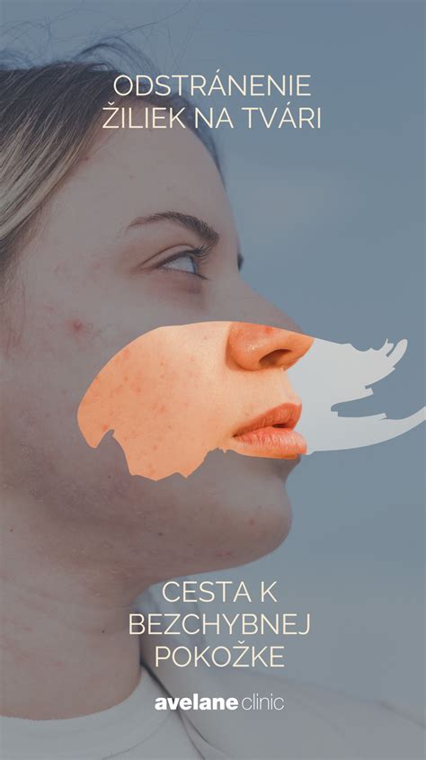 Ilustrácia príznakov rosacey na nose a tvári
