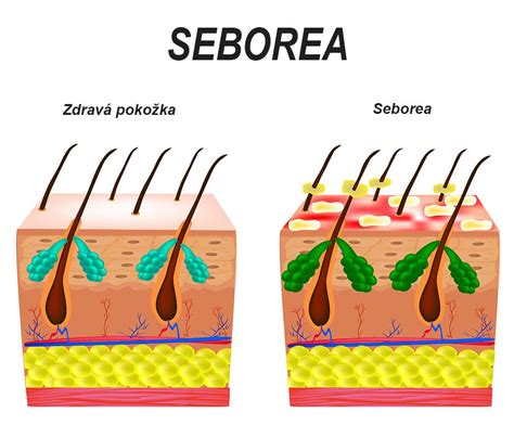 Ilustrácia: porovnanie zdravej kože a kože postihnutej psoriázou
