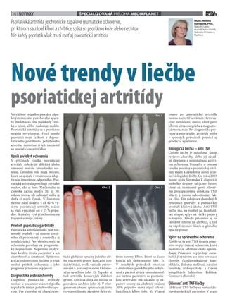 Schéma: Prejavy psoriatickej artritídy na kĺboch