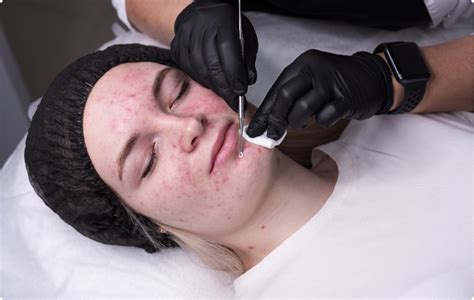 Infografika zobrazujúca rôzne dermatologické procedúry