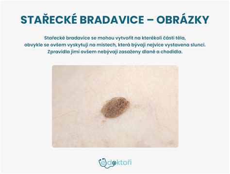 fotografia stareckej bradavice (seboroickej keratózy)
