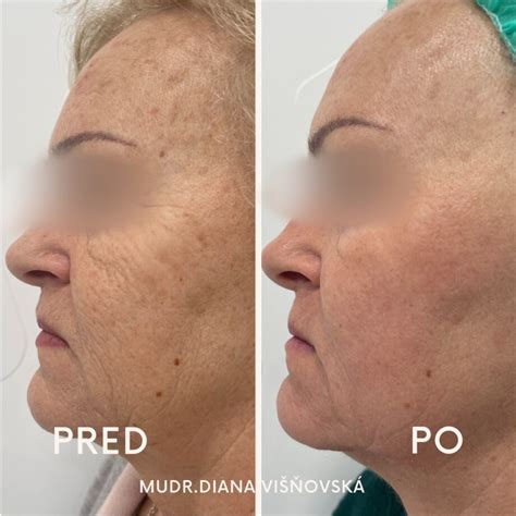 Porovnanie pleti pred a po frakčnom CO2 resurfacingu (pred a po 4 mesiacoch)