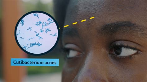 Mikroskopický záber baktérie Cutibacterium acnes