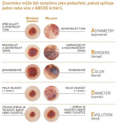 Infografika: Tri hlavné typy rakoviny kože s vizuálnymi príkladmi