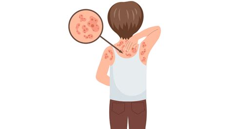 Schéma: Porucha kožnej bariéry pri atopickej dermatitíde