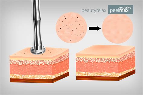 Infografika porovnávajúca výsledky chemického peelingu a mikrodermabrázie