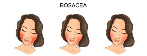 Schéma znázorňujúca prejavy rôznych subtypov rosacey na tvári