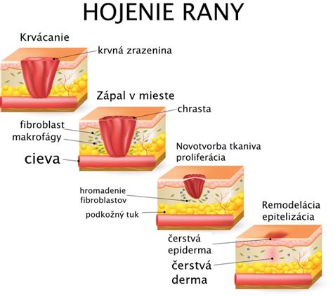 Infografika: Fázy hojenia rany (zápalová, proliferačná, remodelačná)