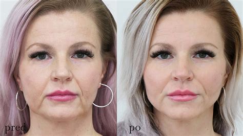 Tematické foto: Detail tváre s problematickou pleťou pred a po použití produktu