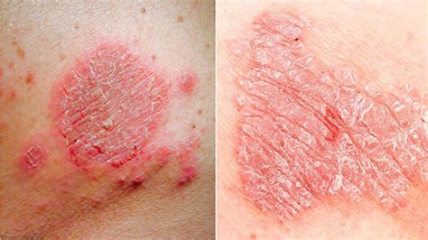 Tematická fotografia: postihnutá koža psoriázou s typickými šupinami