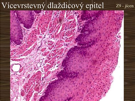 Mikroskopický záber na dlaždicový epitel s prejavmi dysplázie (napr. cervikálna intraepiteliálna neoplázia)