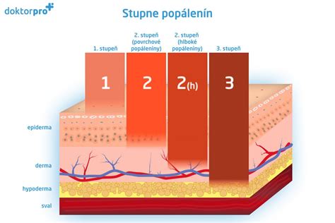 Infografika: Stupne popálenín a ich prejavy