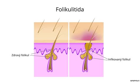 Schéma prierezu kože znázorňujúca hĺbku vlasového folikulu, kde sa tvorí podkožný zápal v porovnaní s bežným komedónom.