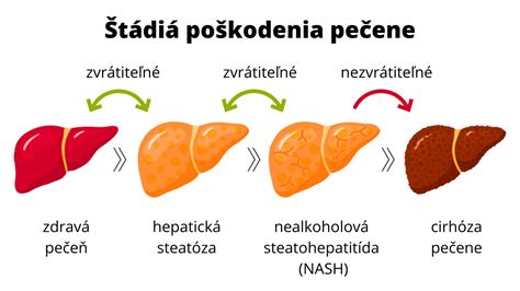 Schéma progresie od zdravej pečene cez fibrózu a steatózu až po cirhózu a vznik väzivových uzlíkov.