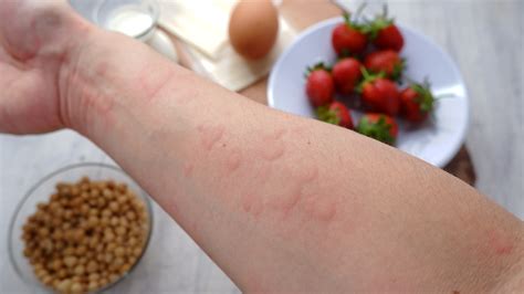 Schéma imunitného systému a alergickej reakcie