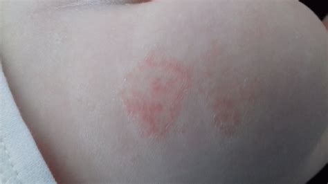 Tematické foto: Červené svrbiace fľaky žihľavky na koži