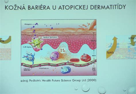 Schéma: Prejavy atopickej dermatitídy na detskej pokožke