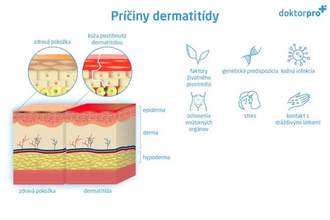 ilustrácia: Kožné prejavy herpetiformnej dermatitídy (svrbiace pľuzgieriky a začervenanie)