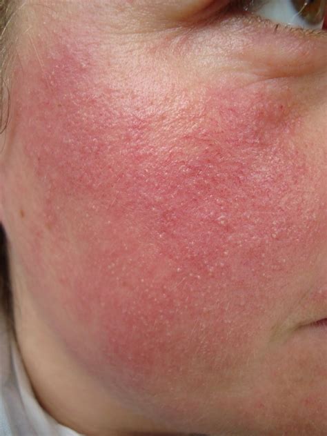 Ilustrácia tváre so začervenanými a šupinatými ložiskami, typickými pre seboroickú dermatitídu.