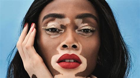 Portrét modelky Winnie Harlow s viditeľným vitiligom