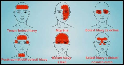 Infografika: Anatomické umiestnenie bežných oblastí bolesti migrény na hlave