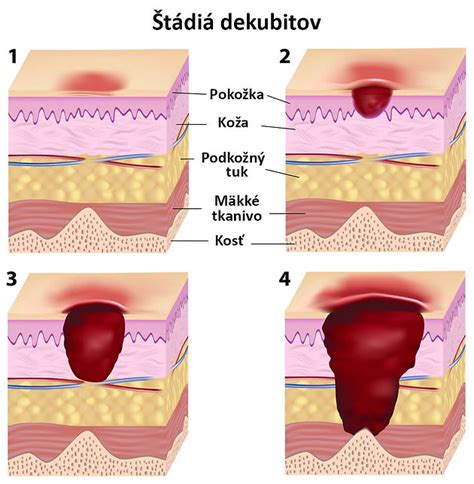 Ilustrácia dekubitu prvého stupňa s neblednúcim erytémom