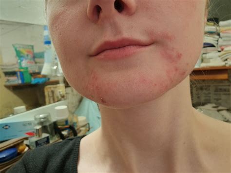 schéma: Periorálna dermatitída - oblasti postihnutia na tvári