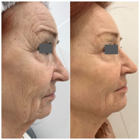 Frakčný CO2 laser: pred a po ošetrení vrások a pigmentácií