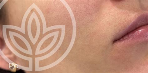 Fotografia pleti s periorálnou dermatitídou v okolí úst