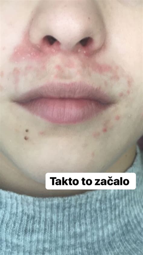 Tematická fotografia ženy s periorálnou dermatitídou okolo úst
