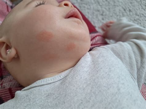 Ilustračná fotografia tváre dieťaťa s jemným začervenaním na líci