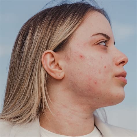 Zväčšený detail zdravej pokožky tváre bez akné.