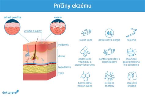 Infografika: Príčiny a spúšťače atopického ekzému