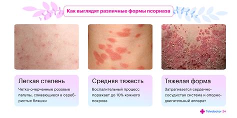 Tematické foto: Psoriatické ložiská na koži