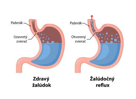 Schéma trávenia micelárneho kazeínu v žalúdku: tvorba gélovitej štruktúry (micel) a postupné uvoľňovanie aminokyselín.