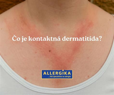 Kontaktná dermatitída na koži po kontakte s alergénom