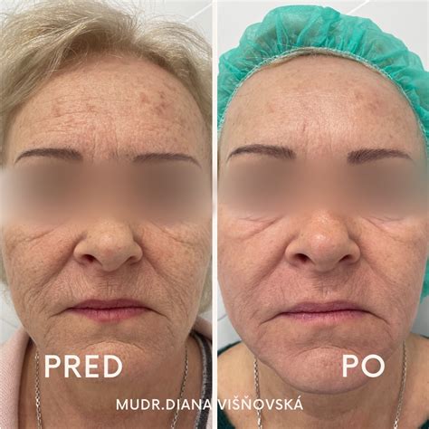 Fotografie pokožky deň po dni počas rekonvalescencie po frakčnom laseri