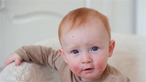 Tematické foto: Dieťa s atopickým ekzémom