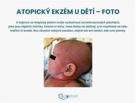 infografika s faktormi vplývajúcimi na atopický ekzém (genetika, prostredie, strava)
