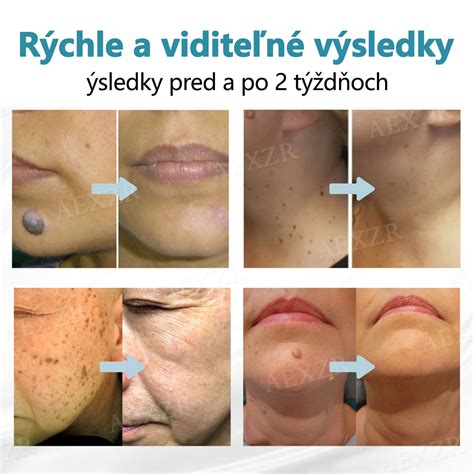 Tematická fotografia rôznych typov bradavíc na pokožke