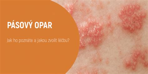 Foto: Priebeh pásového oparu na koži (výsev pľuzgierov)