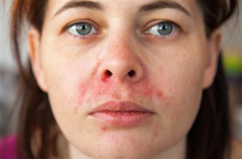 Detailný záber na pokožku s červenými pupienkami a šupinatením v okolí úst (periorálna dermatitída)