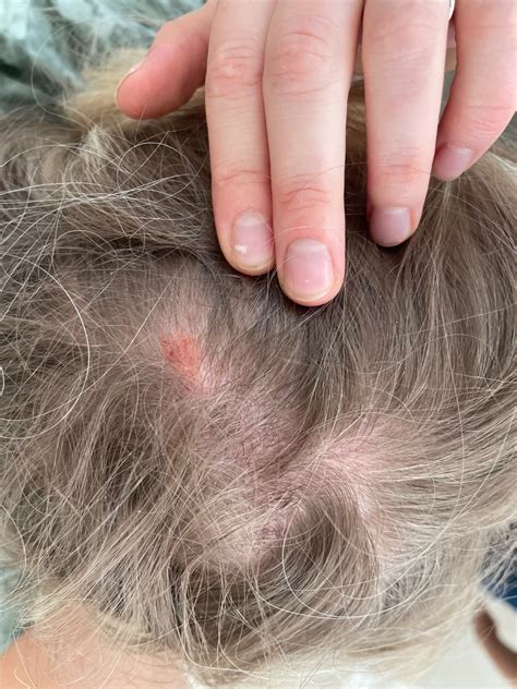 fotografia: dojčenská seborrhoická dermatitída na hlave dieťaťa