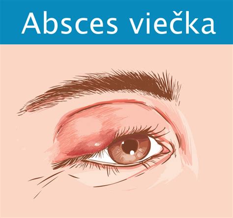 Tematické foto: hrčka na očnom viečku