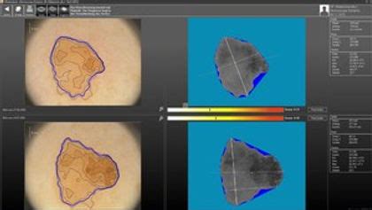 Digitálny dermatoskop na vyšetrenie kože