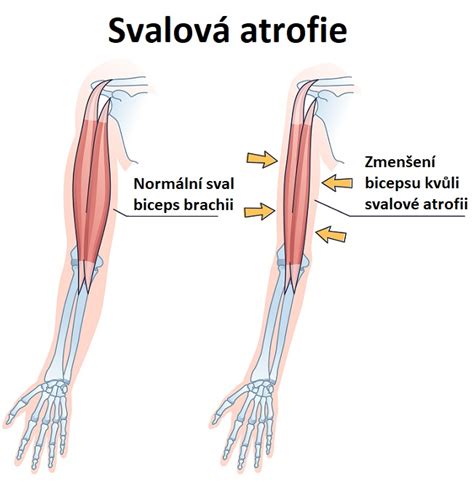 Ilustrácia atrofie kože spôsobenej dlhodobým používaním kortikosteroidov
