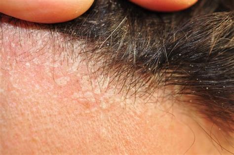 Schéma: Prejavy lupienky a seboroickej dermatitídy na pokožke hlavy