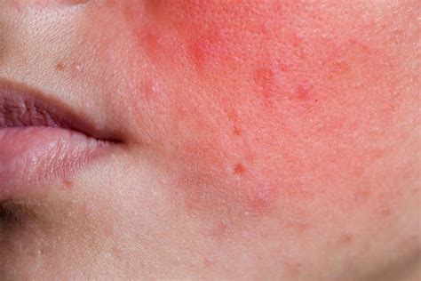 Ilustrácia: Detailný pohľad na kožné prejavy periorálnej dermatitídy (pupienky, začervenanie, šupiny)