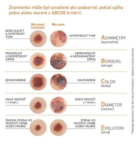 ilustrácia dermatoskopického vyšetrenia znamienka na koži
